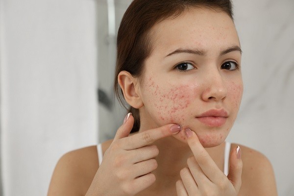 Bí quyết chăm sóc da mụn tại nhà - Các bước đơn giản và hiệu quả để có làn da đẹp và khỏe mạnh