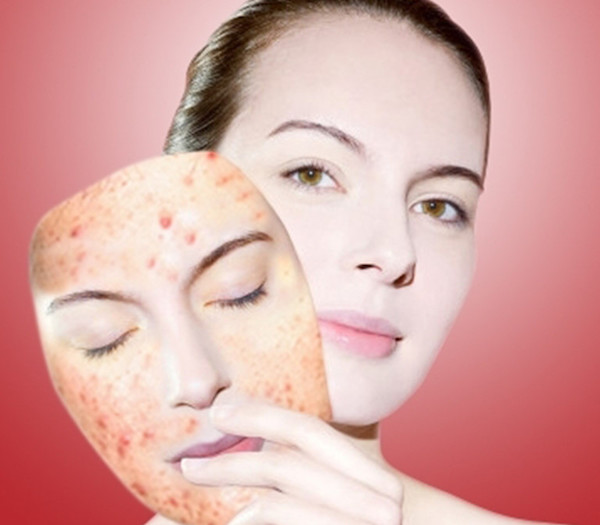 Chế độ ăn khoa học giúp làm sạch mụn và cải thiện da