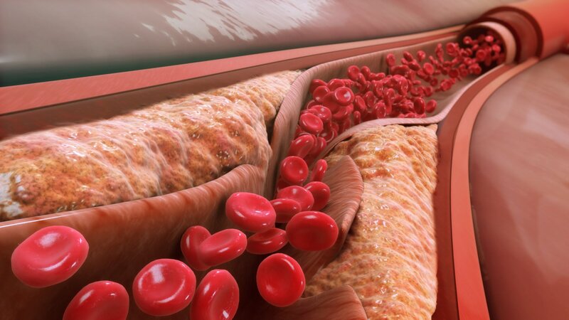 Cholesterol cao: Những phương pháp điều trị hiệu quả mà bạn nên biết